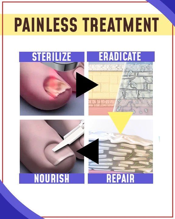 Zestawy przeciwgrzybicze do leczenia niebieskim światłem - Image 2