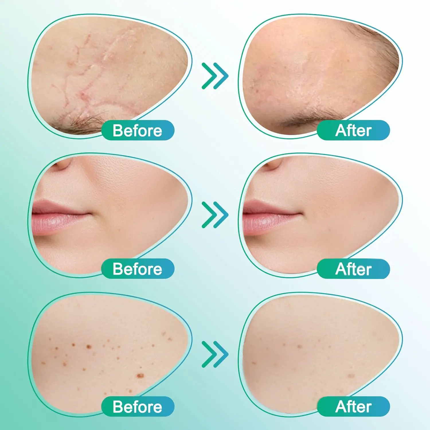 𝗖𝗮𝗿𝗲𝗕𝗿𝗲𝗲𝘇𝗲® Plaster pielęgnacyjny z mikroigłami 3 w 1 - Image 5