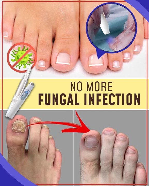 Zestawy przeciwgrzybicze do leczenia niebieskim światłem - Image 3