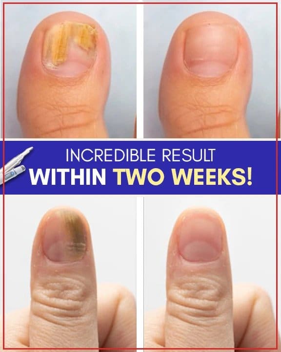 Zestawy przeciwgrzybicze do leczenia niebieskim światłem - Image 5